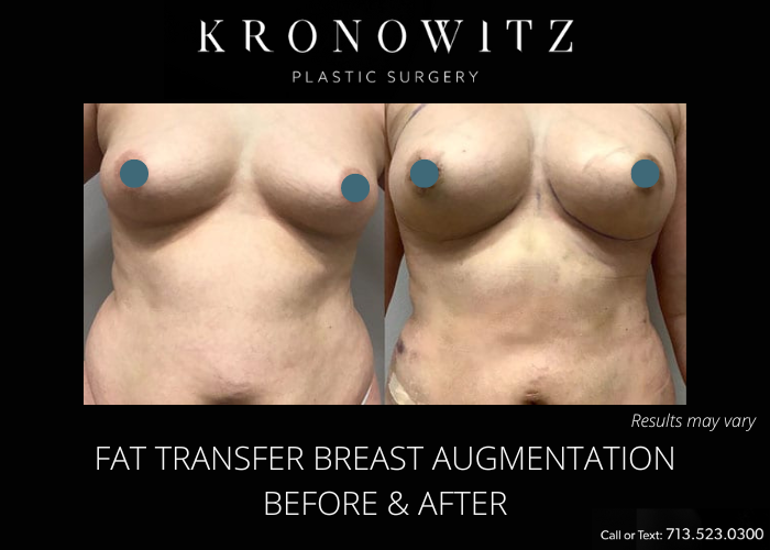 Before and after image showing the results of a fat transfer breast augmentation.