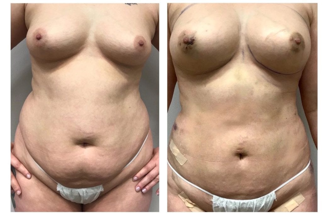 Fat Transfer Breast Augmentation