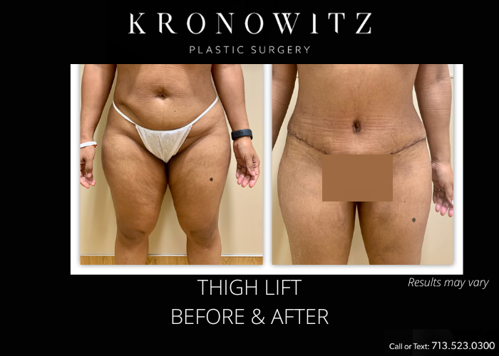 Before and after image showing the results of a thigh lift performed in Houston.