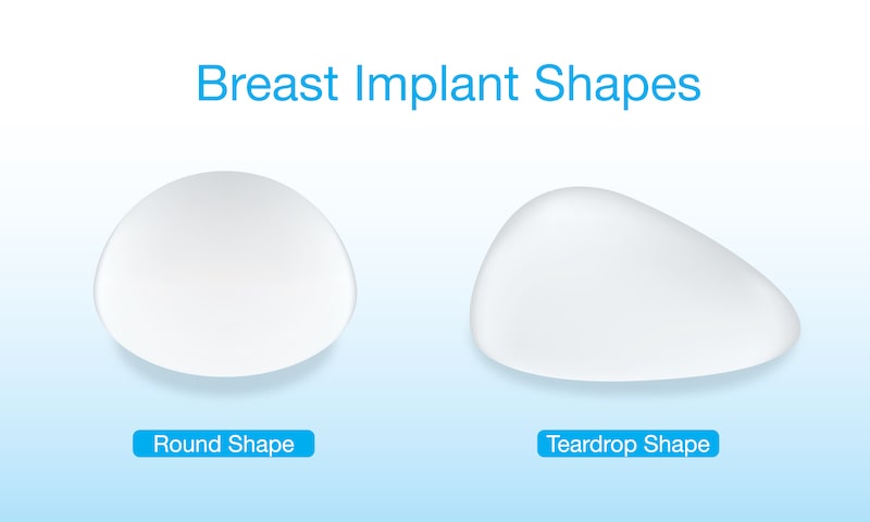 Illustration showing the difference between round and teardrop breast implants.