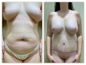 Before and After Image
