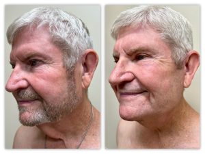 Before and After Image