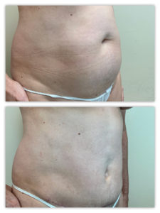 Before and After Image