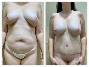 Before and After Image