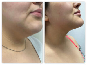 Before and After Image