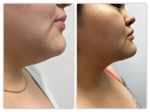 Before and After Image