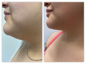 Before and After Image