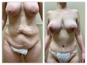 Before and After Image