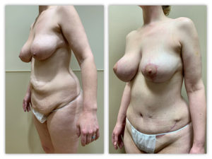 Before and After Image