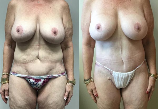Before and After Image