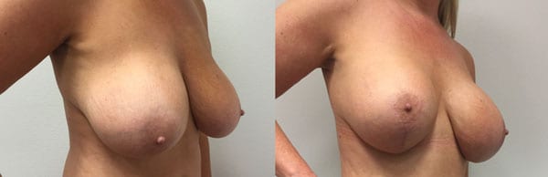 Before and After Image