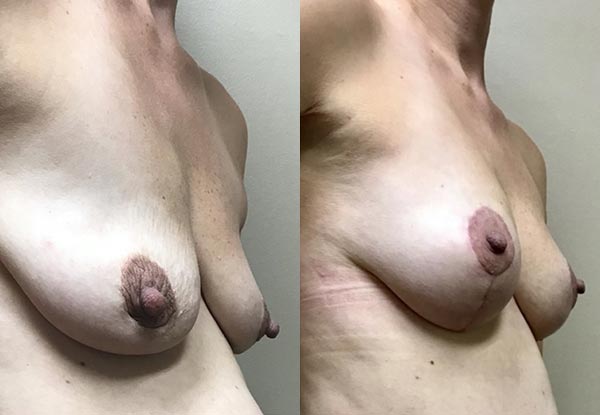 Before and After Image