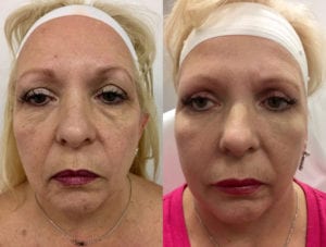 Before and After Image
