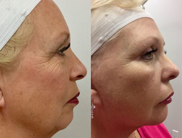 Before and After Image