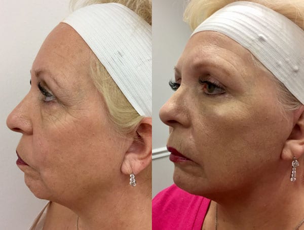 Before and After Image