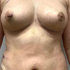 Fat Transfer to Breast