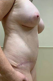 Tummy Tuck Before & After Patient #2918