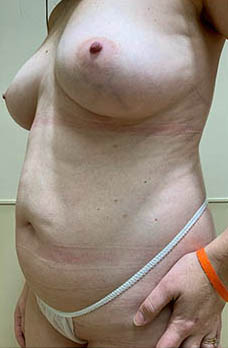 Tummy Tuck Before & After Patient #2918