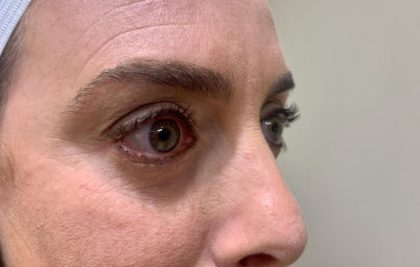 Eyelid Lift Before & After Patient #1780
