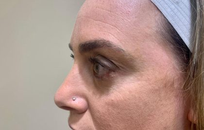 Eyelid Lift Before & After Patient #1780