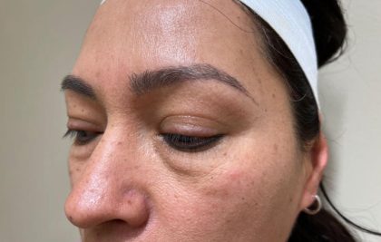 Eyelid Lift Before & After Patient #1783
