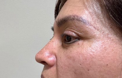Eyelid Lift Before & After Patient #1783
