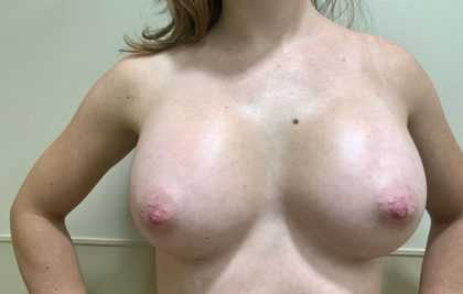 Breast Augmentation Before & After Patient #1763