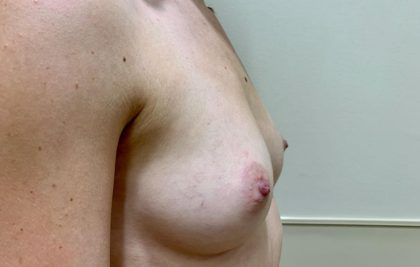 Breast Augmentation Before & After Patient #1763
