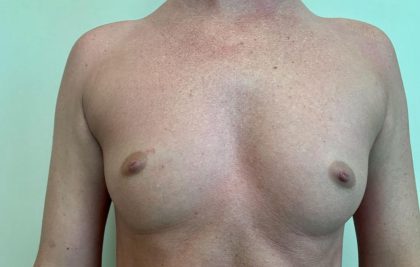Breast Augmentation Before & After Patient #1865