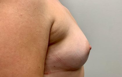 Breast Augmentation Before & After Patient #1877