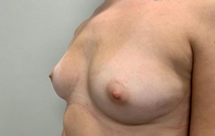 Breast Augmentation Before & After Patient #1877