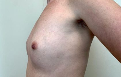 Breast Augmentation Before & After Patient #1878