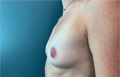Breast Augmentation Before & After Patient #1956