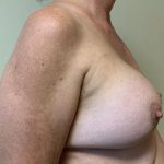 Breast Implant Removal and Replacement Before & After Patient #2240