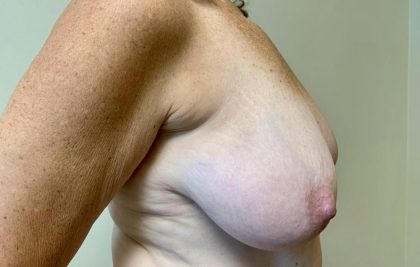 Breast Lift Before & After Patient #2336