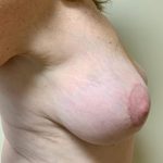 Breast Lift Before & After Patient #2336