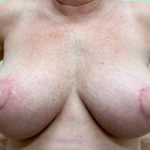 Breast Lift Before & After Patient #2599