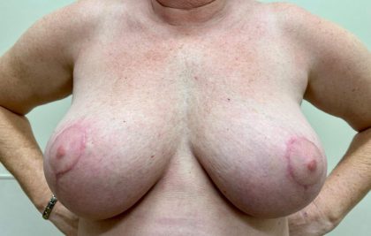 Breast Lift Before & After Patient #2599