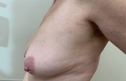 Breast Lift With Augmentation Before & After Patient #3005