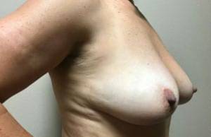 Breast Lift With Augmentation Before & After Patient #2990