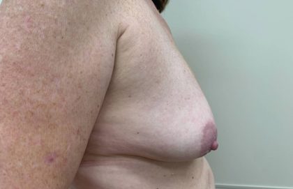 Breast Lift With Augmentation Before & After Patient #3005