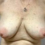 Breast Lift With Augmentation Before & After Patient #3002