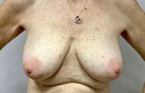 Breast Lift With Augmentation Before & After Patient #3002
