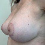 Breast Lift With Implant Exchange Before & After Patient #2499