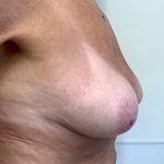 Breast Lift With Augmentation Before & After Patient #2684