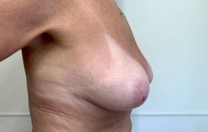 Breast Lift With Augmentation Before & After Patient #2684
