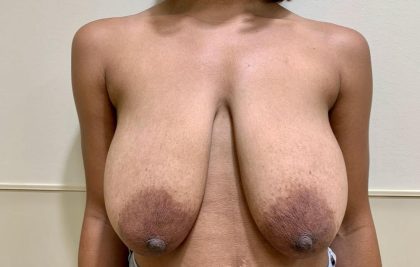 Breast Reduction Before & After Patient #2395