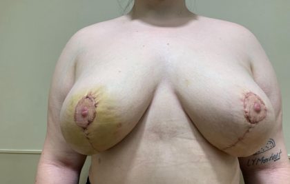Breast Reduction Before & After Patient #2396
