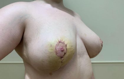 Breast Reduction Before & After Patient #2396
