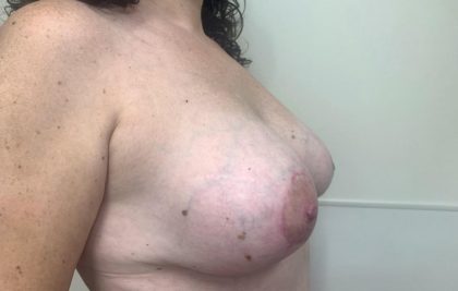 Breast Implant Removal and Replacement Before & After Patient #2259